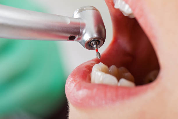 Best Knocked-Out Tooth (Avulsed Tooth) Treatment in Monticello, MN